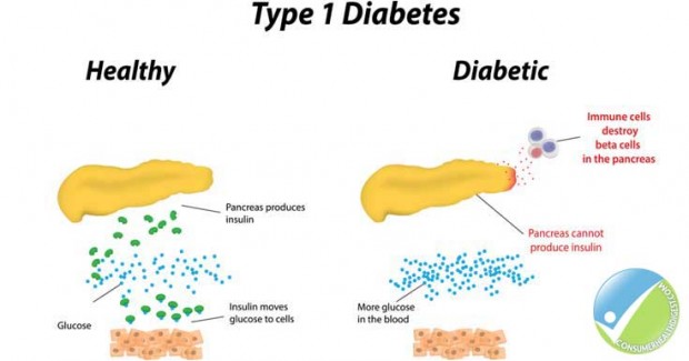 درمان دیابت نوع 1