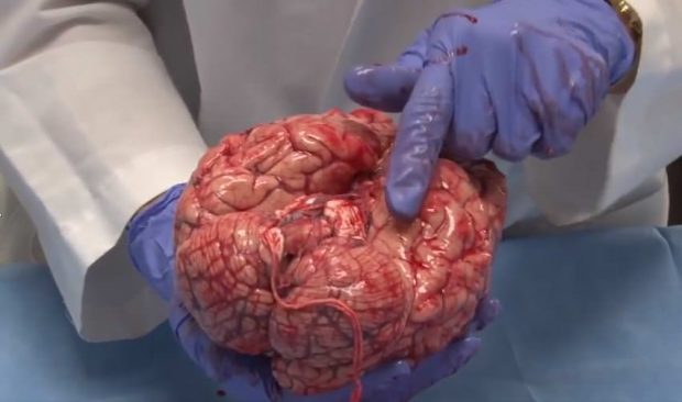 کالبد شکافی مغز انسان را در این ویدیوی شگفت‌انگیز تماشا کنید