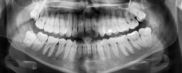 ترمیم خودکار مینای دندان نیاز به پر کردن دندان را از بین می‌برد