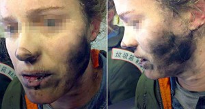 انفجار باتری هدفون ها در هواپیما باعث سوختگی صورت یک زن شد