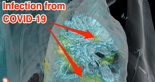 پخش ویدیویی نگران کننده در مورد تاثیر کرونا روی ریه انسان