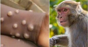 واکسن های بیماری آبله میمون