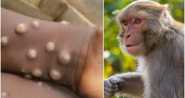 واکسن های بیماری آبله میمون