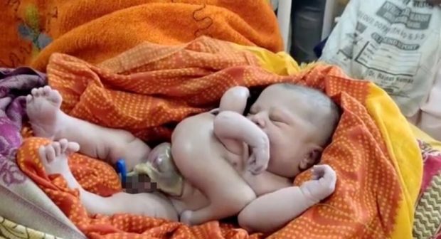نوزادی با چهار دست و پا در هند