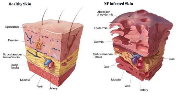 مقایسه پوست سالم با پوست آلوده شده به باکتری