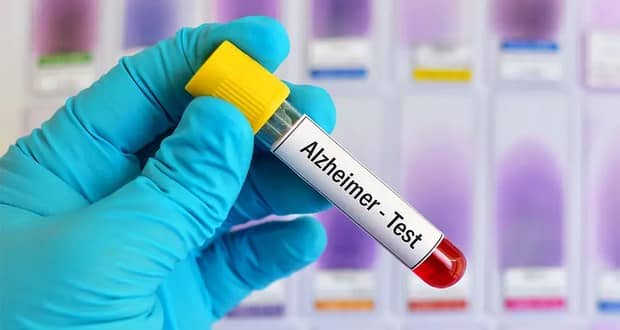 آزمایش خون تشخیص آلزایمر