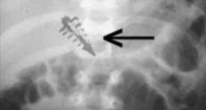 ایمپلنت‌های فرازمینی