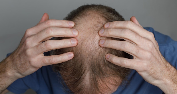 درمان ریزش مو با گیاه چینی