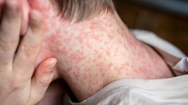 سرخک (Measles)