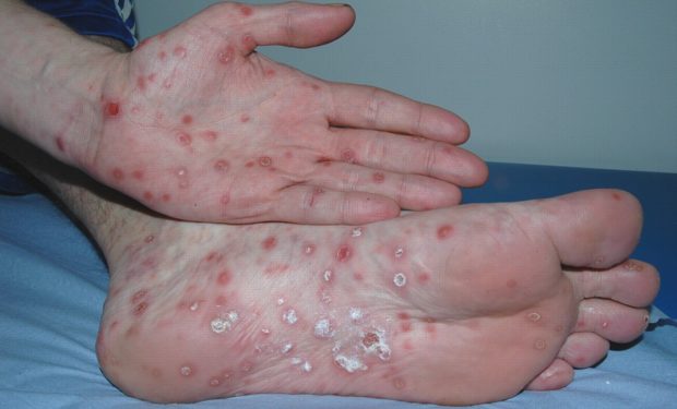 مننژیت (Meningitis)