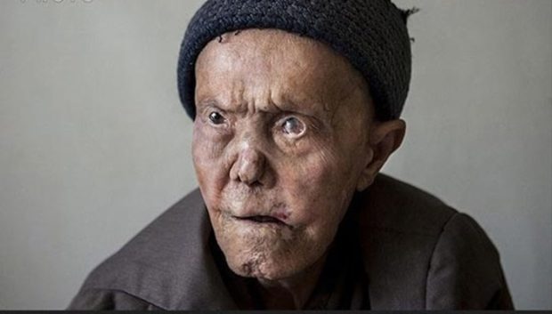 جذام (Leprosy)