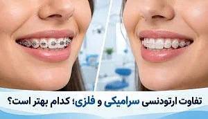 تفاوت ارتودنسی فلزی و سرامیکی