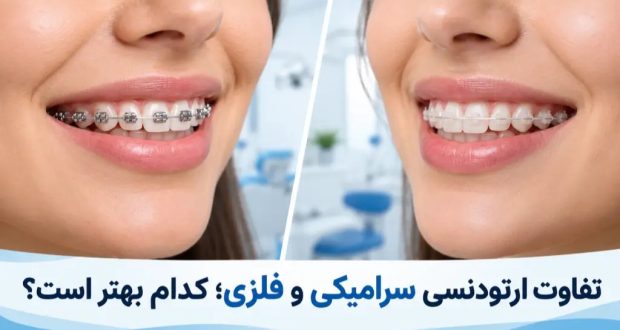 تفاوت ارتودنسی فلزی و سرامیکی